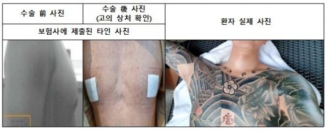 보험사에 제공된 가짜 사진(왼쪽)과 가짜 환자 사진